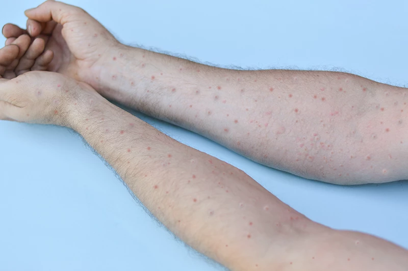 bintik merah pada kulit