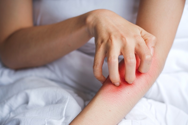 cara menghilangkan bekas gigitan nyamuk