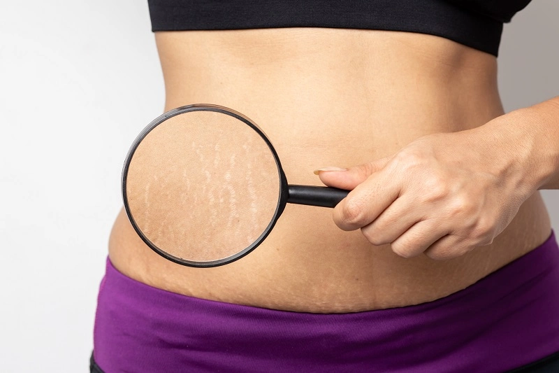 cara menghilangkan stretch mark secara alami